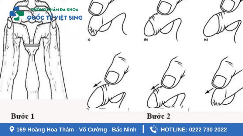 Hướng dẫn chi tiết cách lột bao quy đầu tại nhà