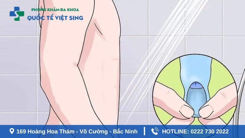 Một số lưu ý khi tiến hành lột bao quy đầu