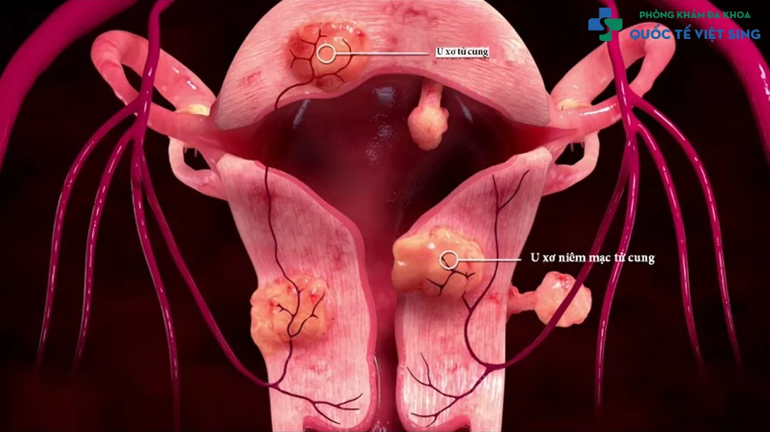 U xơ cổ tử cung là gì?