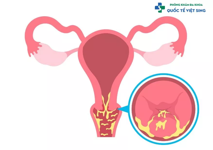 Viêm lộ tuyến cổ tử cung là gì?