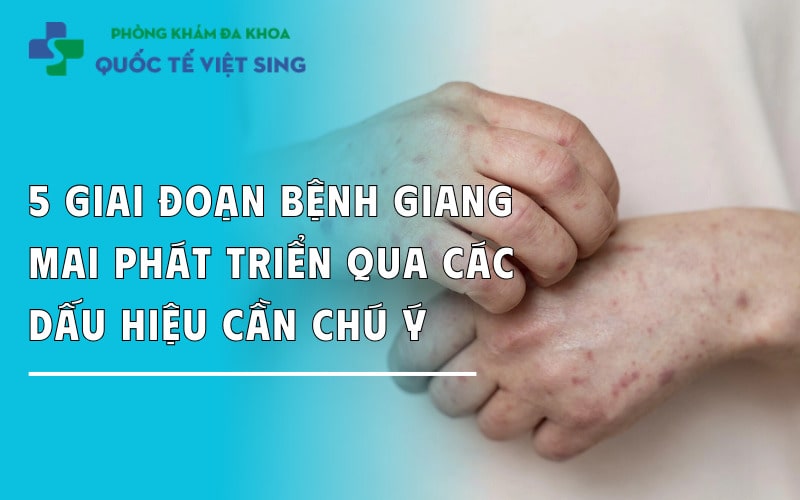 5 Giai đoạn bệnh giang mai phát triển qua các dấu hiệu cần chú ý