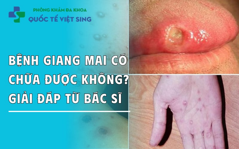 https://dakhoaquoctebacninh.com/wp-content/uploads/2023/07/benh-giang-mai-co-the-chua-khoi-duoc-khong-giai-dap-tu-ba-si.jpg