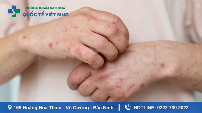 Bệnh giang mai có chữa được không?