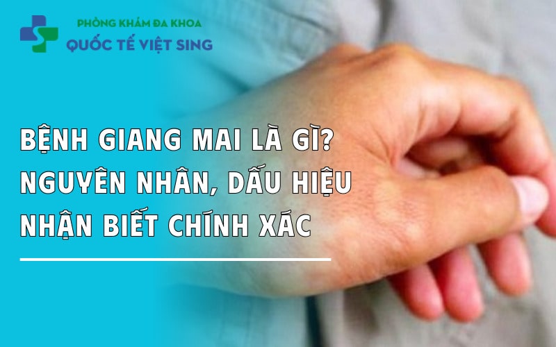 https://dakhoaquoctebacninh.com/wp-content/uploads/2023/07/benh-giang-mai-la-gi-nguyen-nhan-dau-hieu-nhan-biet.jpg