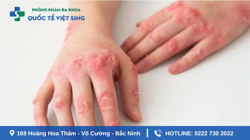 Bệnh giang mai là gì ? Nguyên nhân do đâu