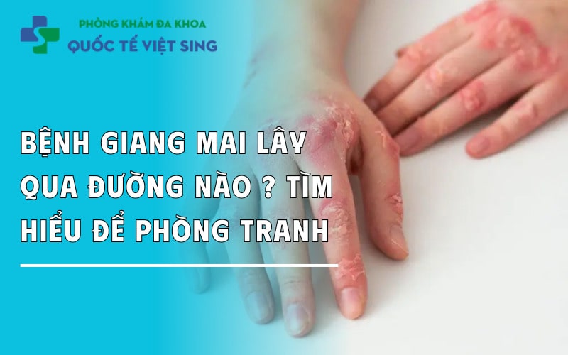 Bệnh giang mai lây qua đường nào? Tìm hiểu để phòng tránh