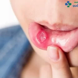 Bệnh giang mai ở miệng – Nguyên nhân và dấu hiệu