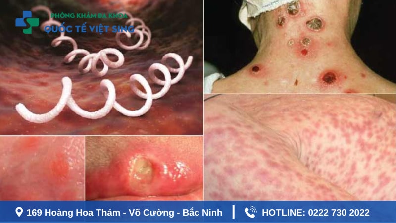 Bệnh giang mai lây qua đường nào ?