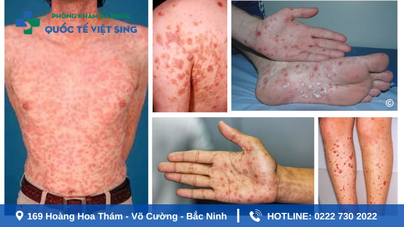 Biến chứng bệnh giang mai khi không được chữa trị kịp thời