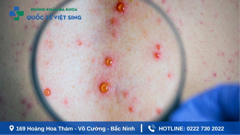 Biện pháp phòng tránh nguy cơ mắc bệnh giang mai?