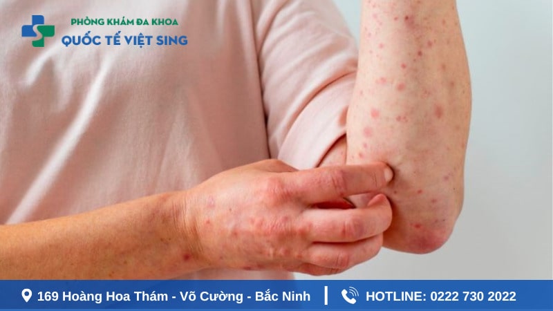Cần làm gì khi phát hiện mắc bệnh giang mai?