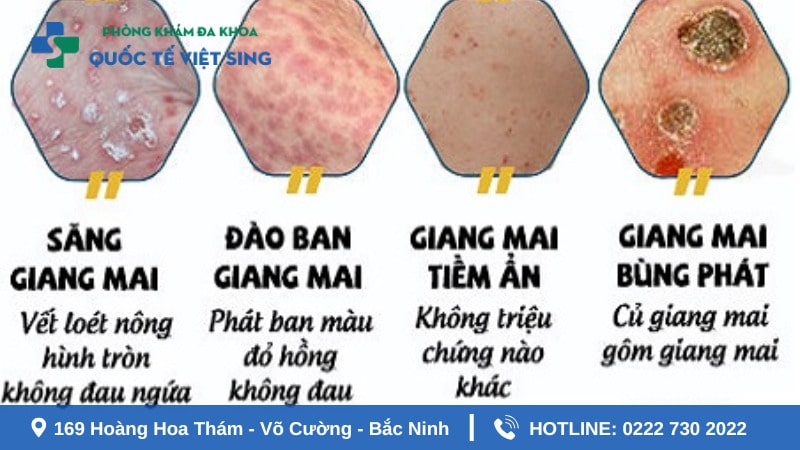 Dấu hiệu bệnh giang mai chính xác qua từng giai đoạn