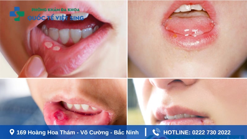 Dấu hiệu bệnh giang mai là gì ? Có nguy hiểm không?
