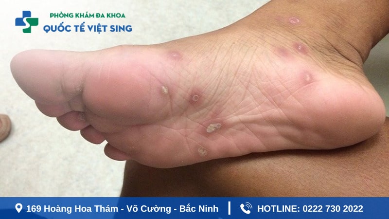 Dấu hiệu phát hiện giang mai giai đoạn sớm