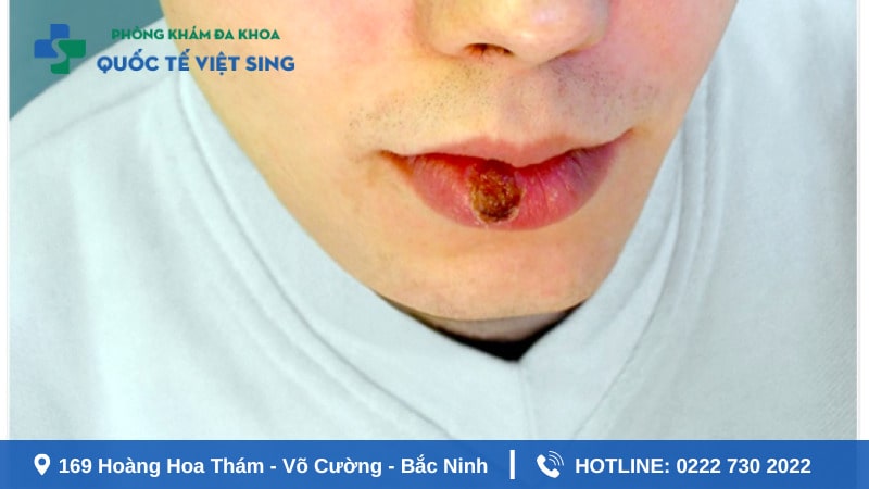 xét nghiện và điệu trị bênh giang mai hiệu quả