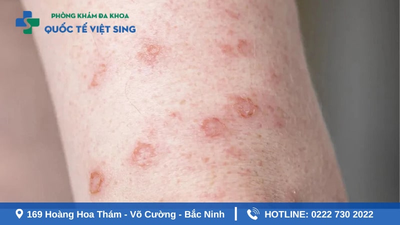 Hình ảnh giang mai giai đoạn đầu nguyên phát