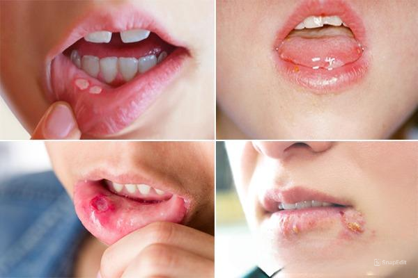 Hình ảnh bệnh giang mai ở miệng cần chú ý