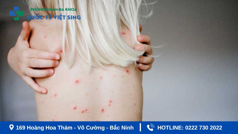 Biểu hiện bệnh giang mai ở nữ giai đoạn 2