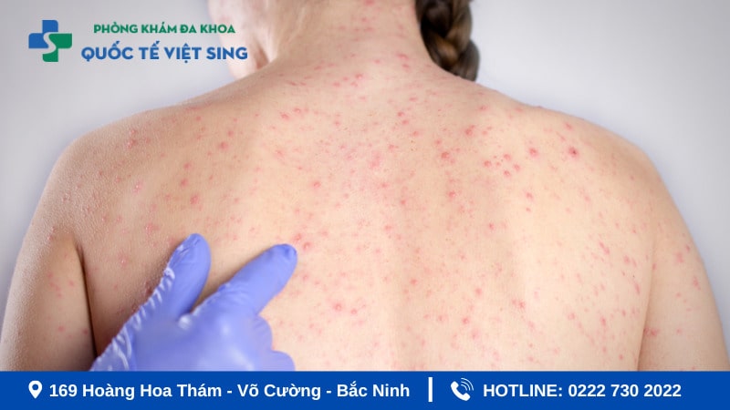 Hình ảnh bệnh giang mai ở nữ giai đoạn tiềm ẩn