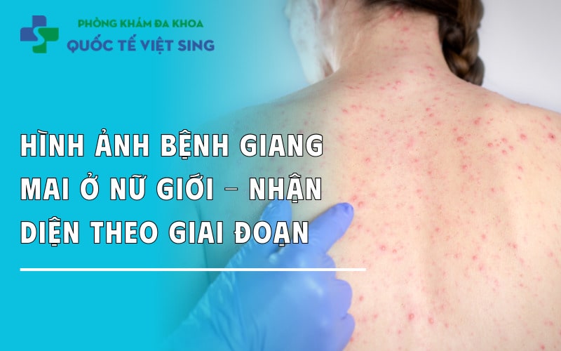 Hình ảnh bệnh giang mai ở nữ giới – Nhận diện theo giai đoạn