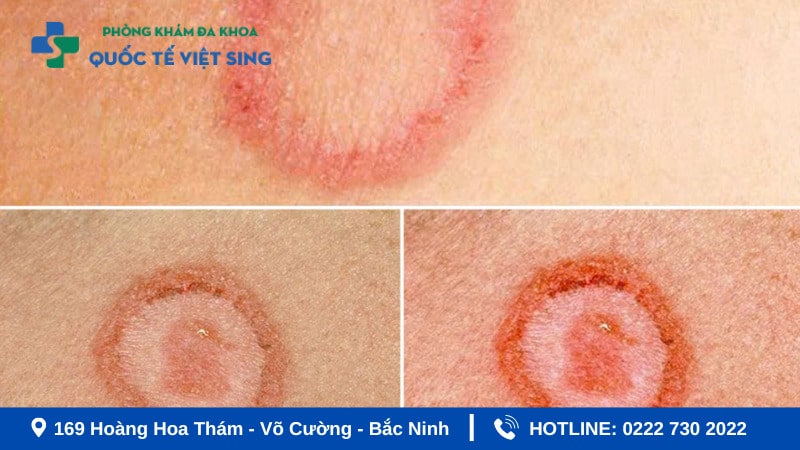 Hình ảnh bệnh giang mai ở nữ giai đoạn nguyên phát