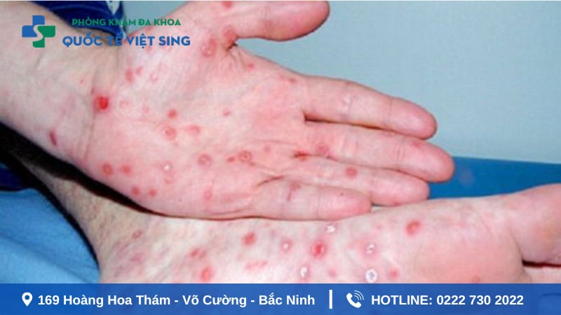 Hình ảnh giang mai giai đoạn hai thứ phát