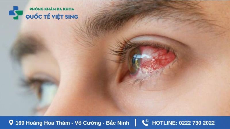 Hình ảnh bệnh giang mai giai đoạn cuối ( lan toả )