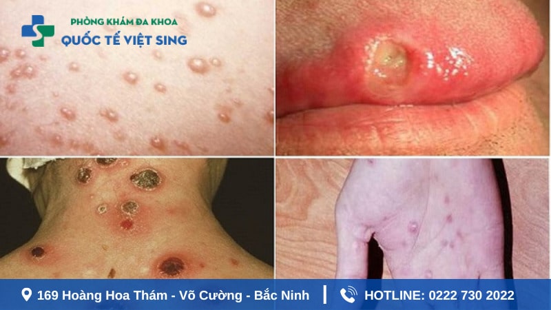 Nguyên nhân gây bệnh giang mai cần chú ý
