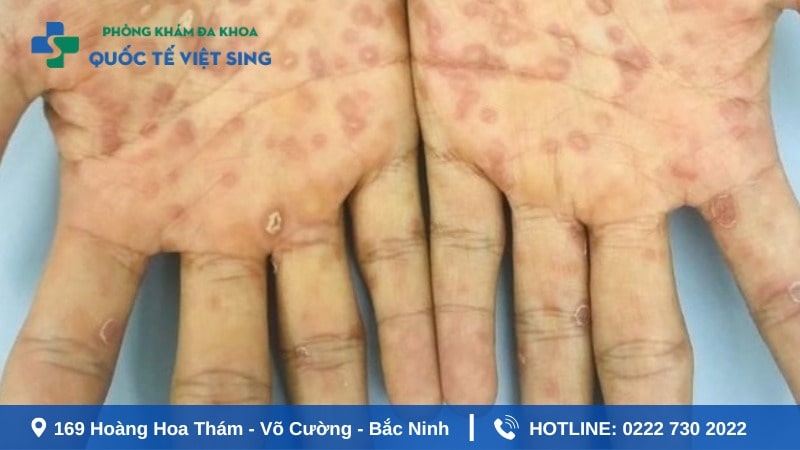 Biến chứng nguy hiểm của giang mai có thể xảy ra