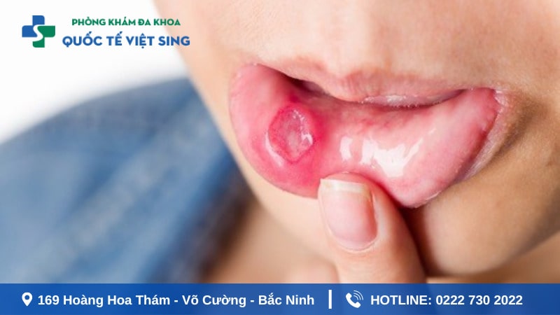 Tìm hiểu bệnh giang mai ở miệng là gì ?