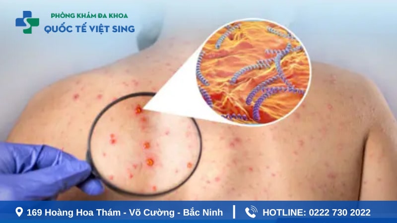 Tìm hiểu đôi nét về bệnh giang mai