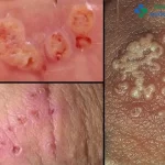 [TỔNG HỢP] Hình ảnh viêm niệu đạo ở nam và nữ đầy đủ qua các giai đoạn 