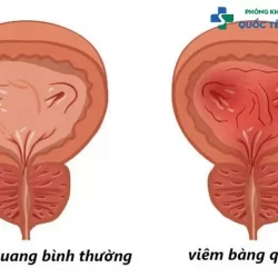 https://dakhoaquoctebacninh.com/wp-content/uploads/2023/10/viem-bang-quang-nen-an-gi-1.jpg-250x250.webp