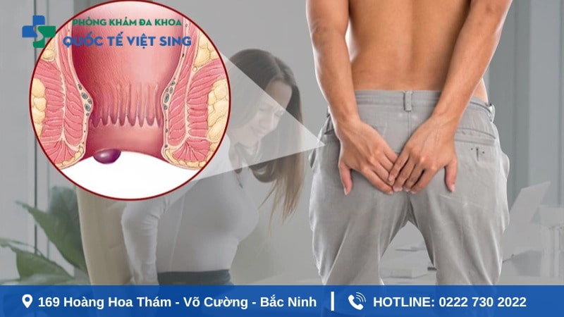 Biện pháp phòng ngừa bệnh trĩ hiệu quả tại nhà