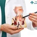 Khám trĩ như thế nào: Những điều quan trọng cần biết