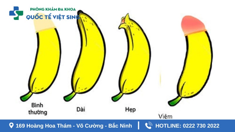 Nhóm đối tượng nên cắt bao quy đầu