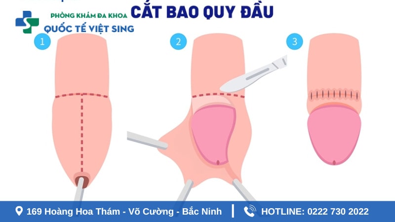 Biện pháp xử lý tình trạng hẹp bao quy đầu ở trẻ em an toàn