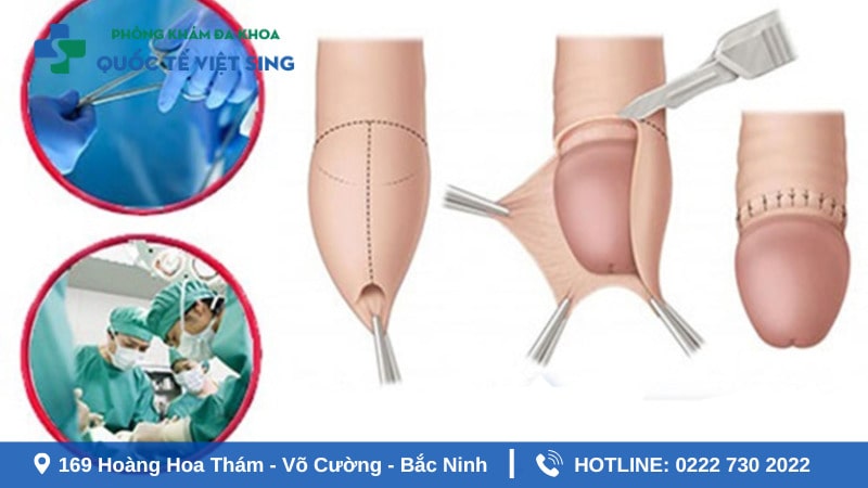 Chi tiết quy trình cắt bao quy đầu an toàn