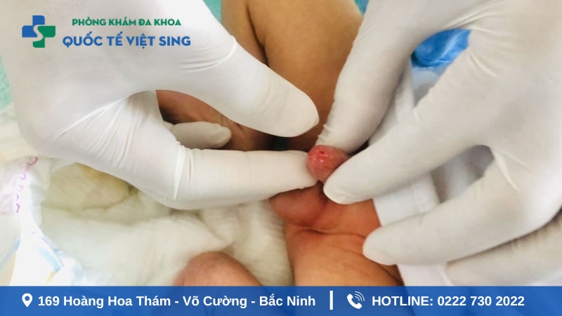 Nguyên nhân gây hẹp bao quy đầu ở trẻ nhỏ là gì?