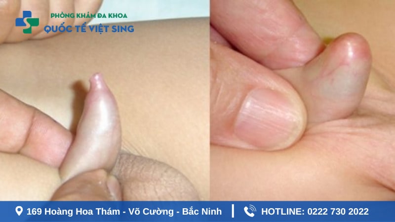 Hẹp bao quy đầu ở trẻ em là gì? 