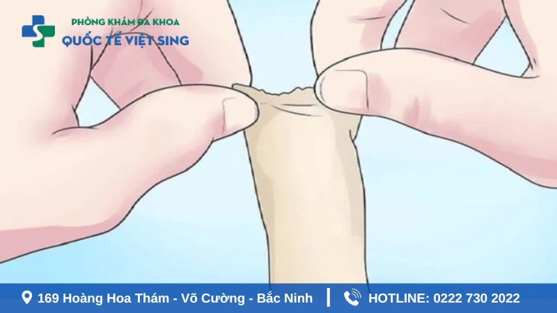 Bao nhiêu tuổi thì lột bao quy đầu?