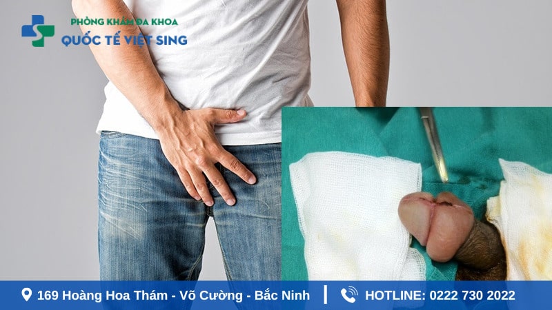 Tình trạng bao quy đầu bị sưng mọng nước không thể chủ quan