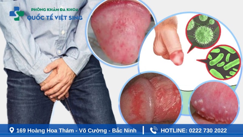Biến chứng khi không điều trị viêm bao quy đầu kịp thời