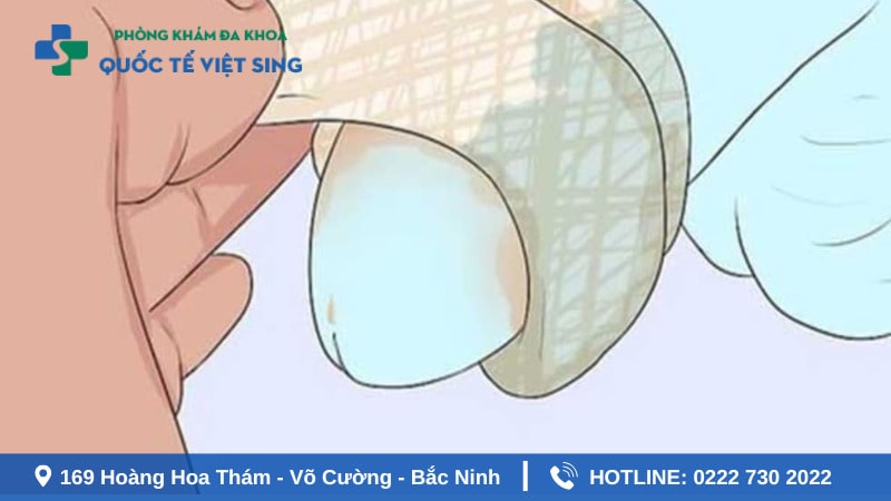 Cách xử lý khi bị sẹo sau khi cắt bao quy đầu hiệu quả