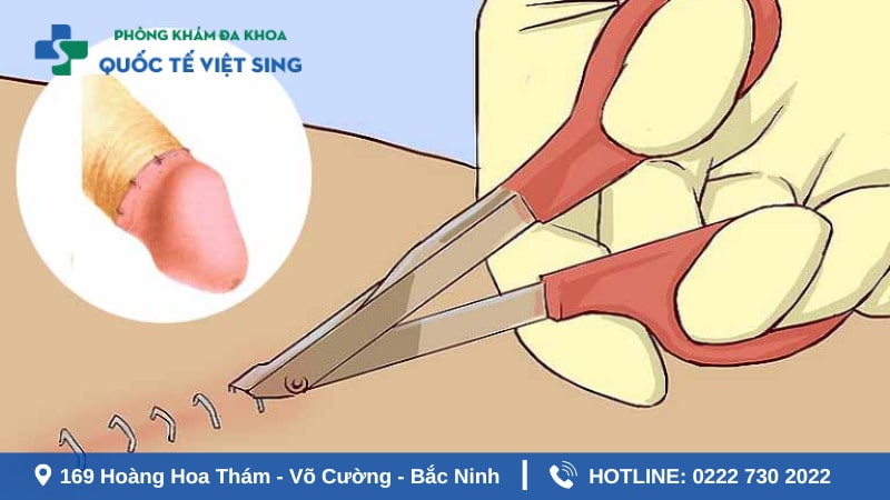 Cắt bao quy đầu bao lâu thì lành phụ thuộc vào phương pháp