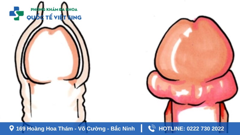 Dấu hiệu nhận biết sẹo sau khi cắt bao quy đầu