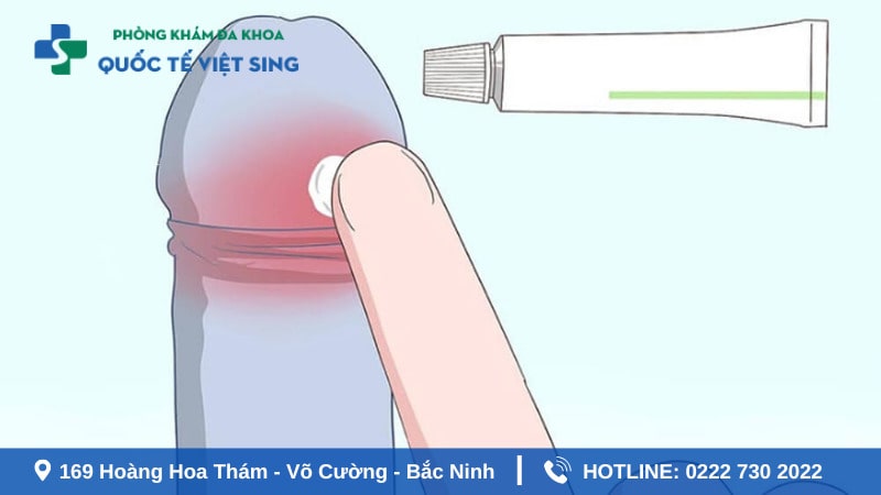 Các các điều trị tình trạng bao quy đầu bị sứng mọng nước