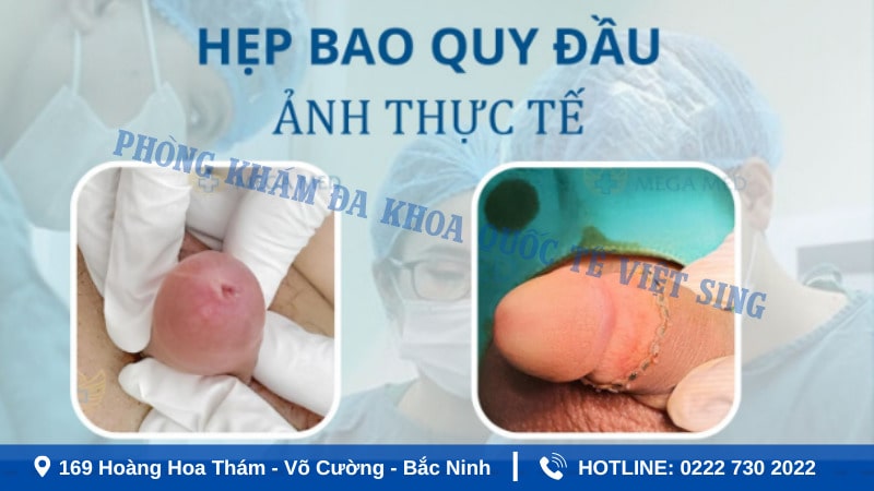 Hình ảnh khi cắt bao quy đầu bị hẹp sau 7-10 ngày