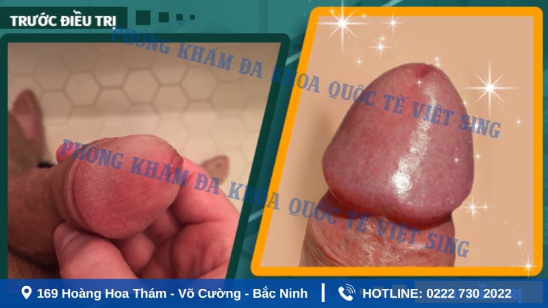Hình ảnh dương vật sau khi cắt bao quy đầu – Giai đoạn 2 đến 3 tuần