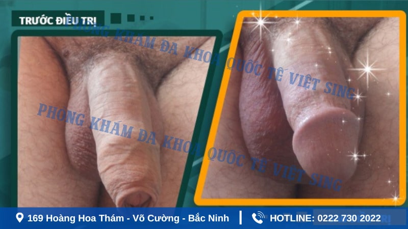 Hình ảnh sau khi cắt bao quy đầu - Giai đoạn sau 1 tháng